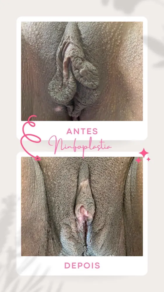 Antes e depois — ninfoplastia