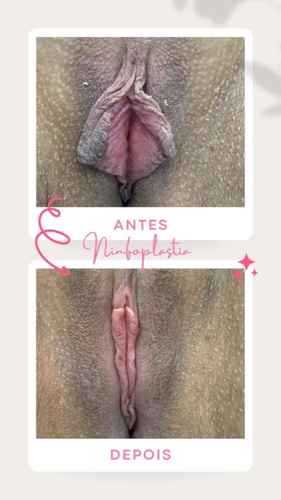 Antes e depois — ninfoplastia
