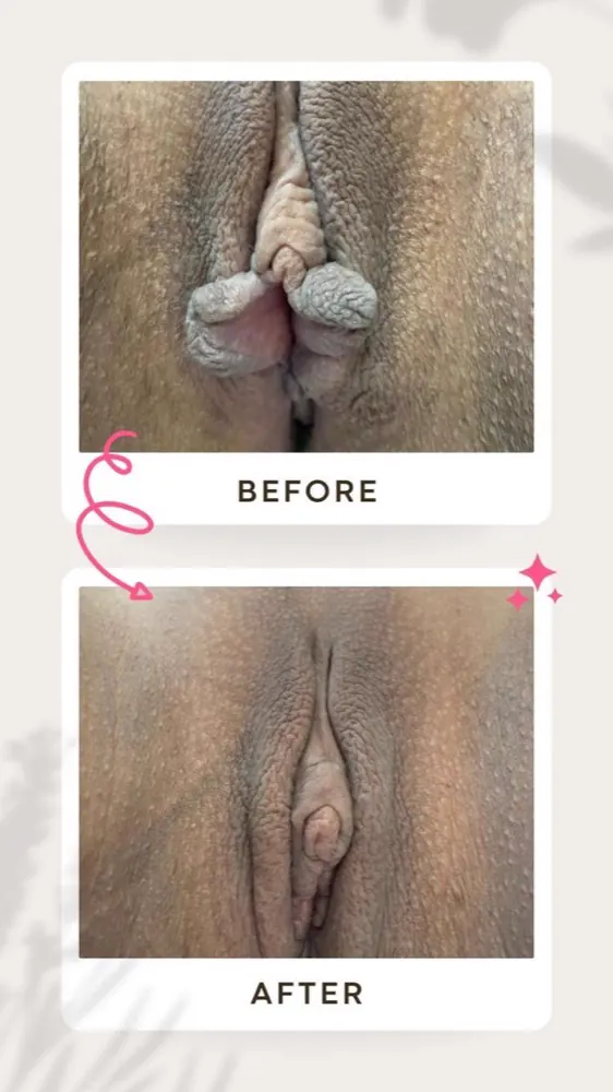 Antes e depois — ninfoplastia