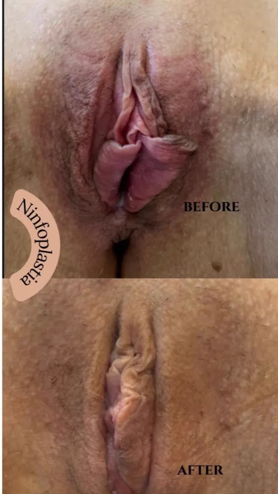 Antes e depois — ninfoplastia