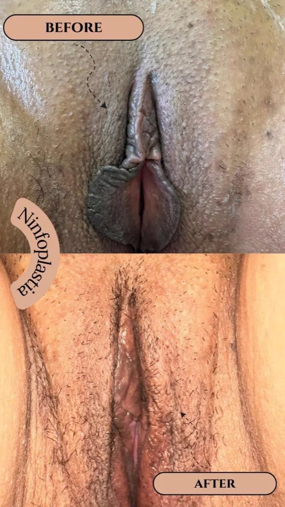 Antes e depois — ninfoplastia