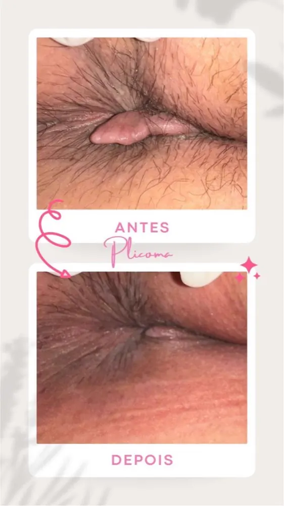 Antes e depois — plicoma anal