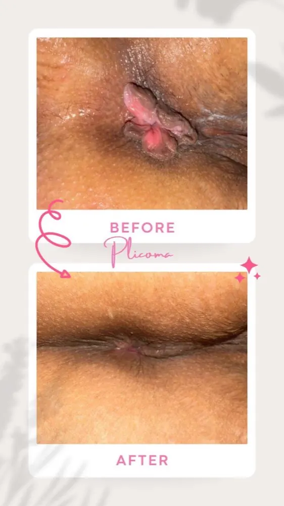 Antes e depois — plicoma anal