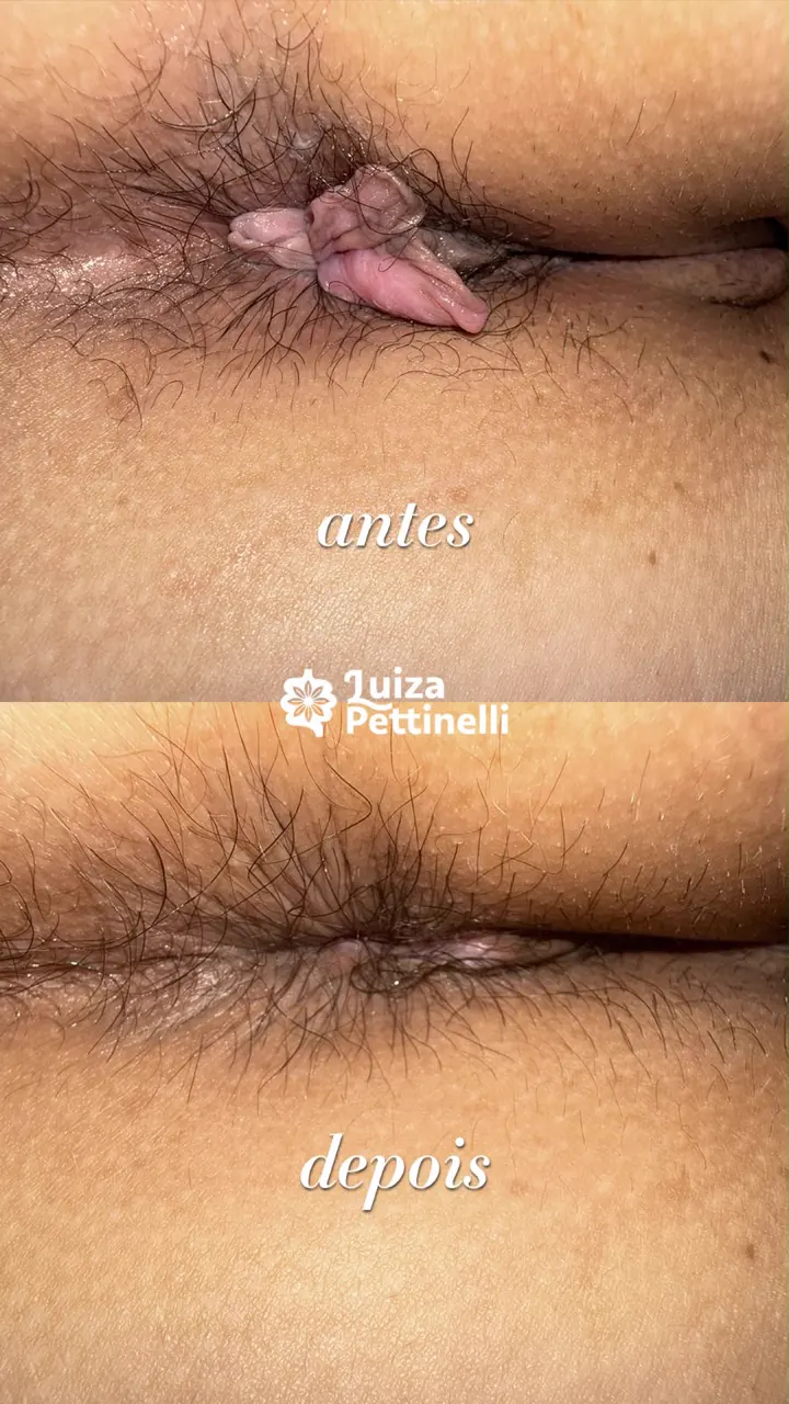 Antes e depois — plicoma anal